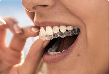 Invisalign