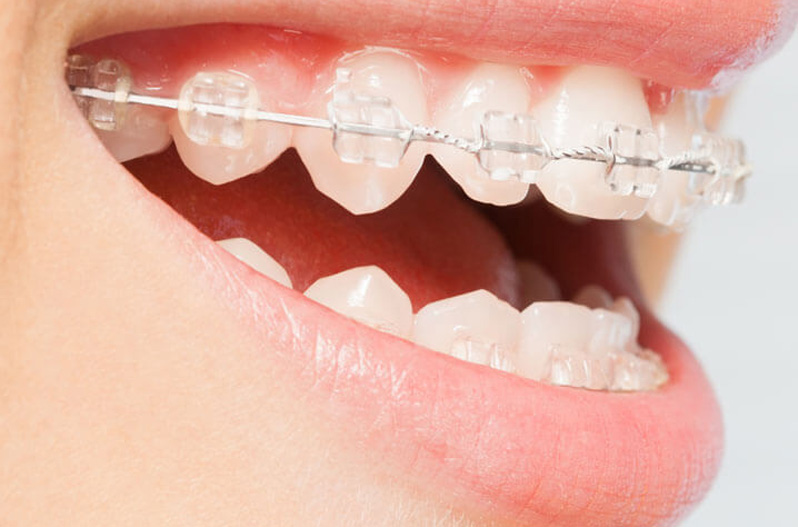 White Braces, Ceramic Braces Leicester