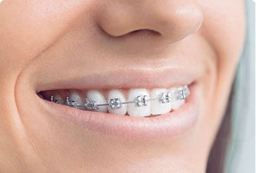 Metal Braces