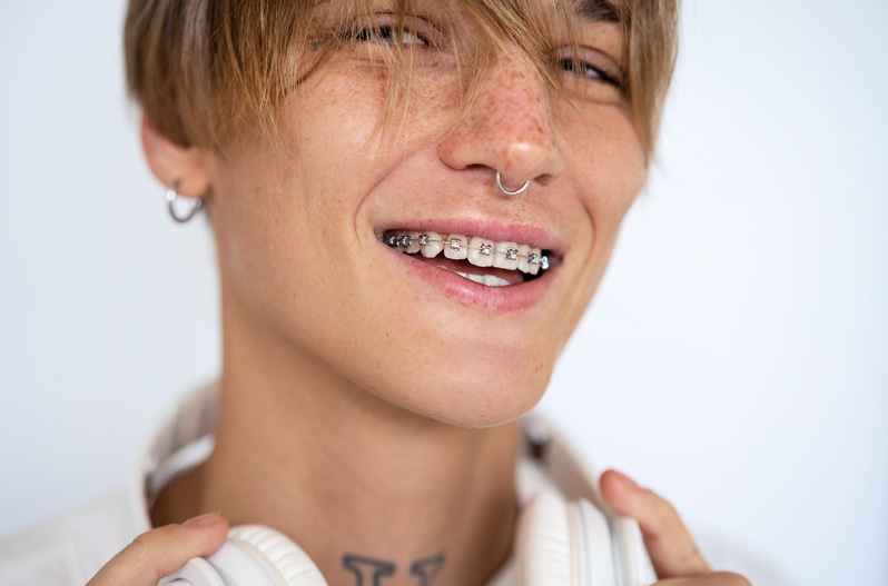 Iconix® Aesthetic Braces
