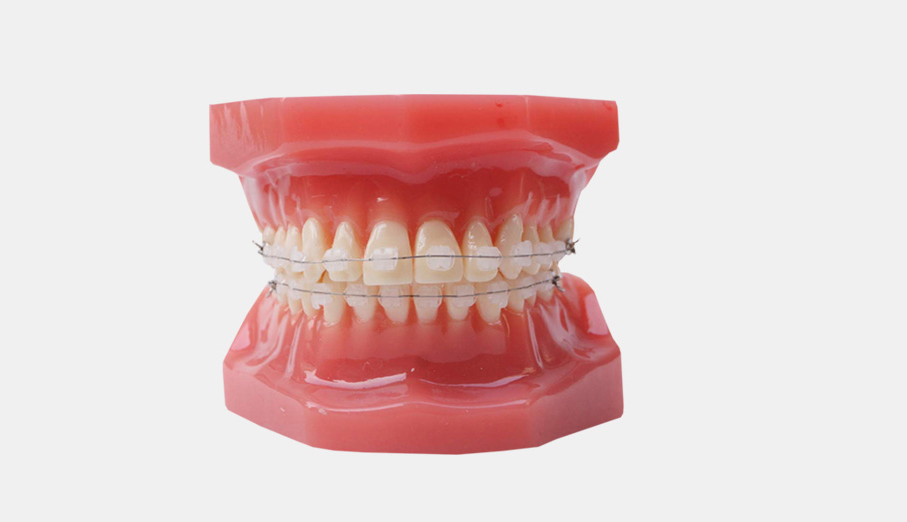 Ceramic braces