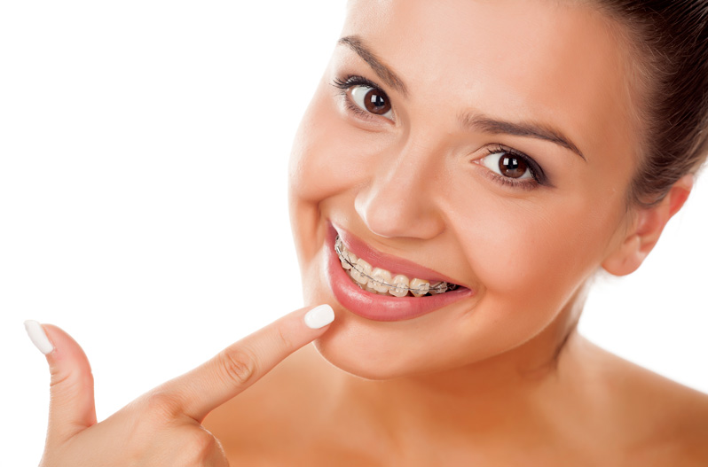 Cosmetic white braces