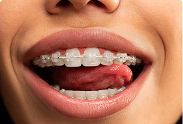 Cosmetic white braces