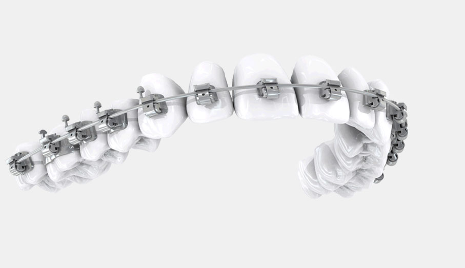 Adult orthodontic treatment