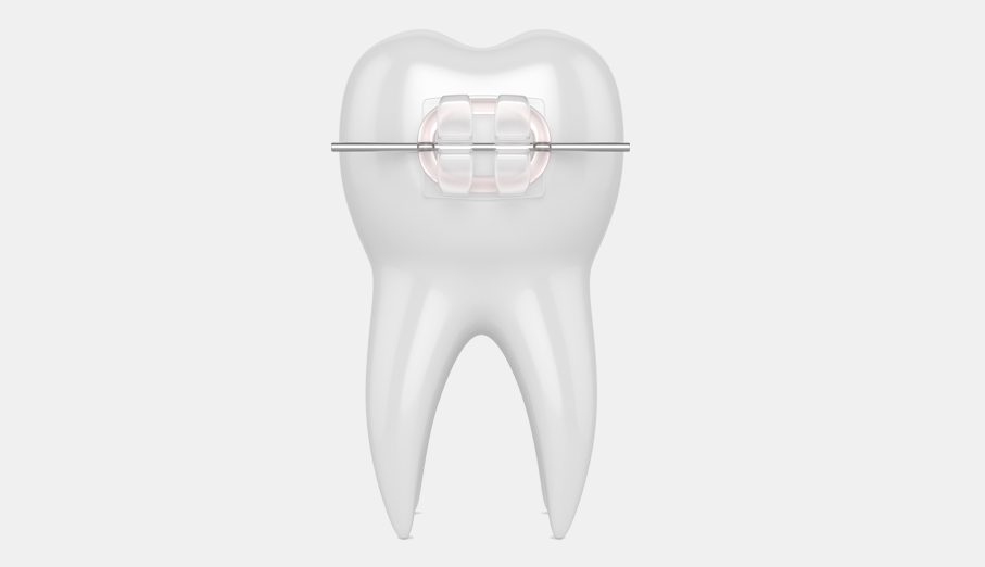 Ceramic braces