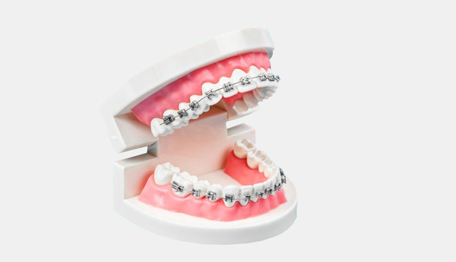 Archwires  UK Adult Braces