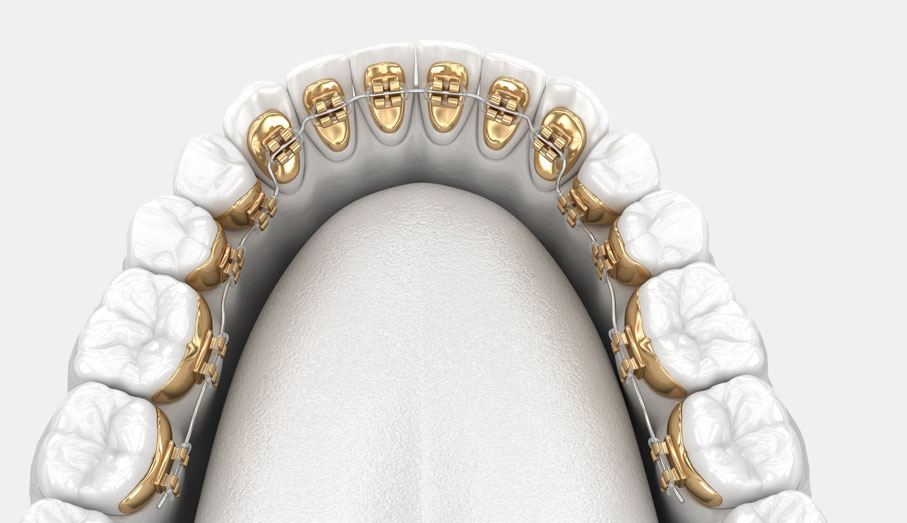 Lingual braces